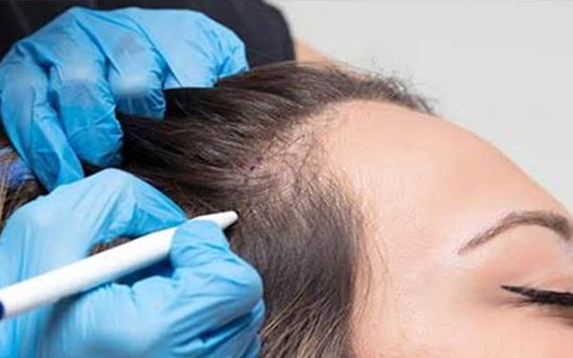 hair transplant cost in mumbai for male