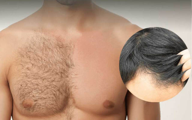 hair transplant cost in mumbai