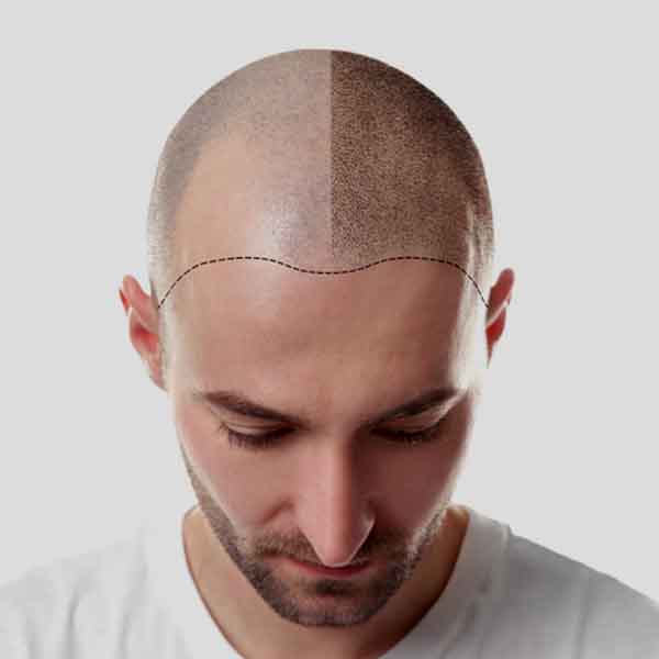 hair transplant cost in mumbai